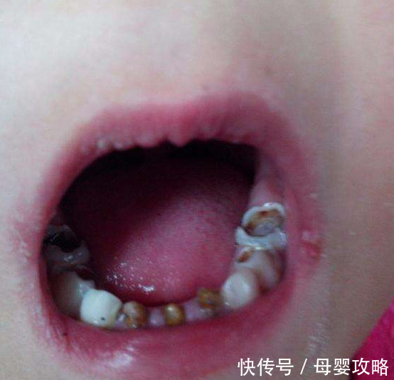 生活中孩子有很多不好的习惯都会导致蛀牙,她这一嘴烂牙还会疼.