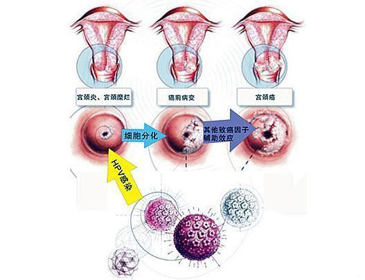 有宫颈hpv病毒 利普刀术后还会有病毒吗
