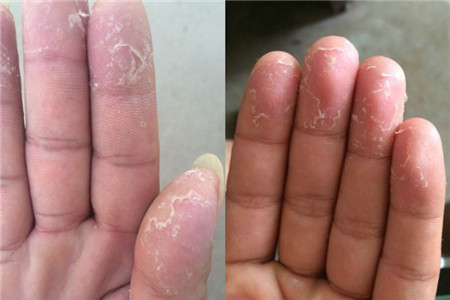 【图】解答手脱皮吃什么维生素 鱼类和蔬菜效果较好