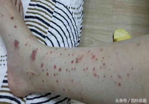 注意:出现这些症状要排查过敏性紫癜 好发于儿童及青少年,开始可有