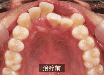 做烤瓷牙的不归路:你只看到明星表面的光鲜,却没看到背后的心酸