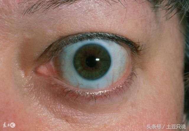 1,眼球变黄 肝炎和肝硬化等肝功能异常都会引起胆红素积聚,导致巩膜