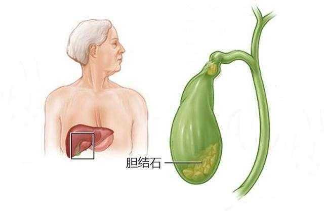 这8种人容易得胆结石, 有你吗?