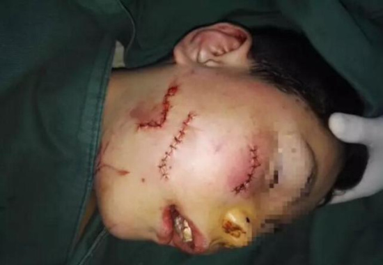 惨惨惨!徐州10岁男孩莫名被邻居狂砍数刀 舌头断裂