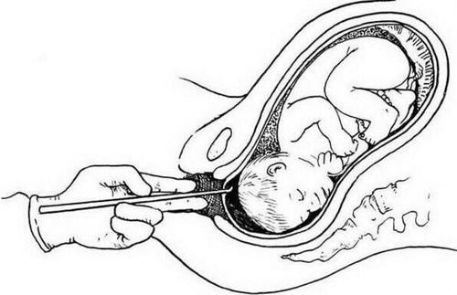 孕妇流产时胎儿是怎么"打掉"的看完你还敢做流产吗?