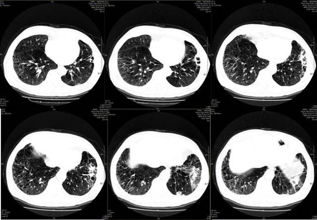 胸部ct示:双肺气肿伴两下肺炎症,两上肺多发空洞或空腔性病变,并左上