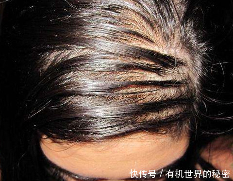 头皮螨虫怎么去除