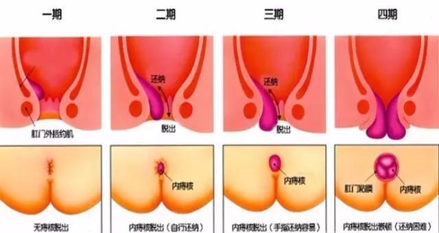 2,影响正常行走,痔疮晚期,痔疮脱出需要用手扶回,严重者咳嗽,跑步