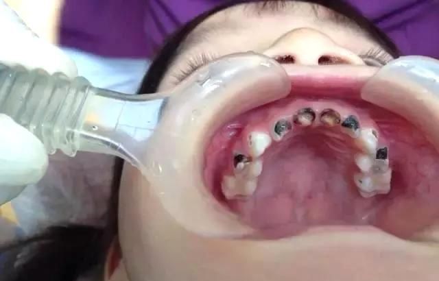 小孩子牙齿烂个洞该怎么办_两岁儿童烂牙齿图片_牙齿烂洞特别疼怎么办