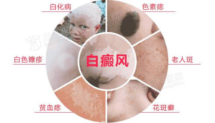 郑州西京教你如何正确的区分"白斑",别在它面前做傻子