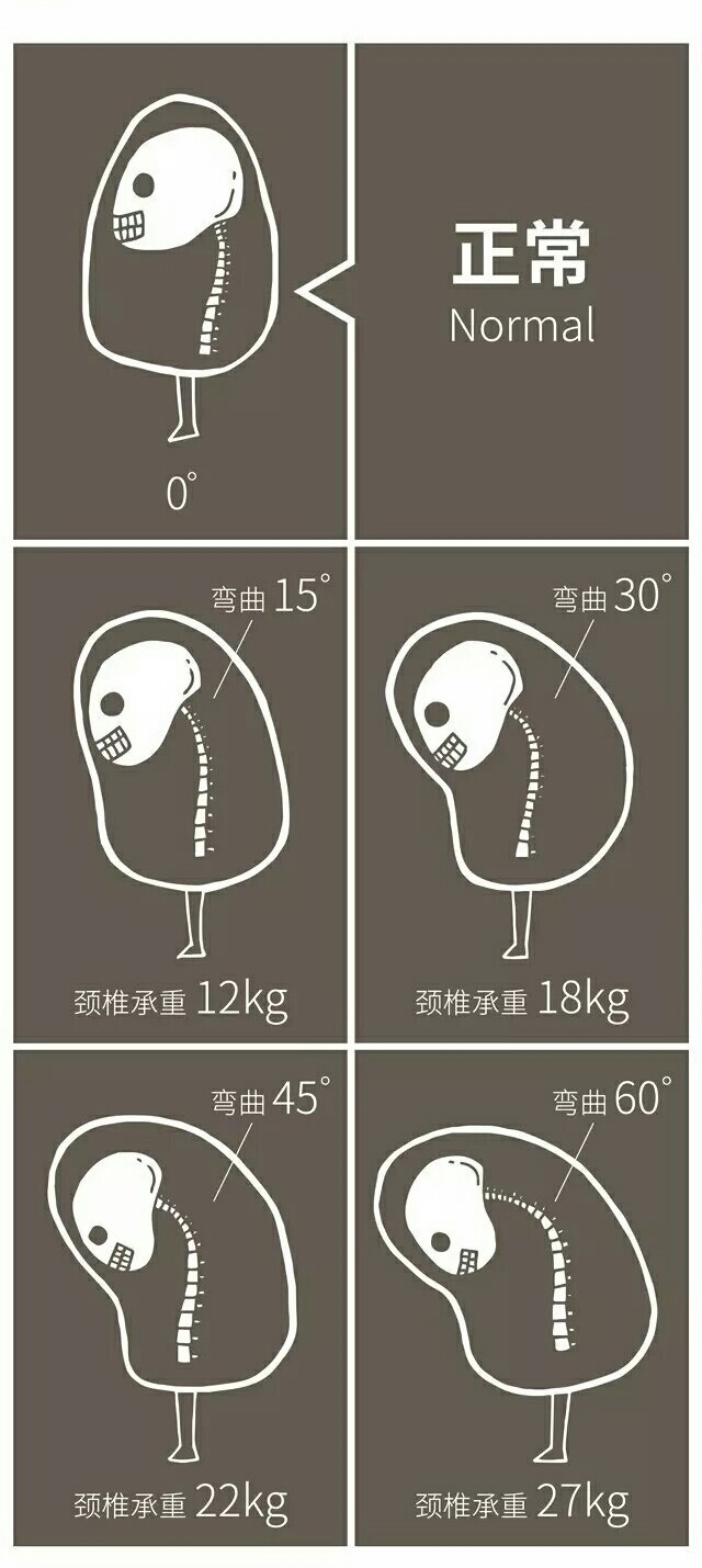 随着颈椎向前屈曲度数的增加,除了颈椎间盘压应力的急剧增加外,颈后部