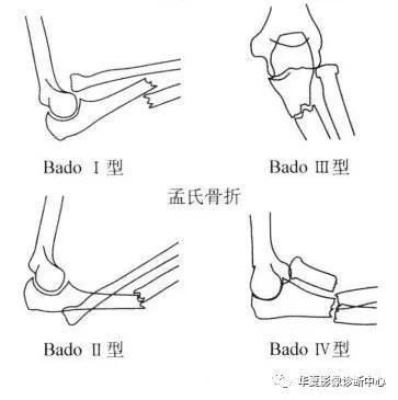 i型(前侧型或伸展型):尺骨骨折向前成角,桡骨头向前脱位; ii型(后侧