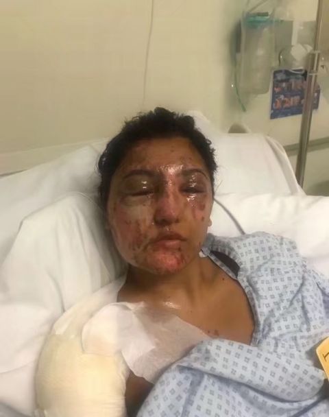 21岁美女被泼浓硫酸,瞬间面目全非,两个月后奇迹发生了
