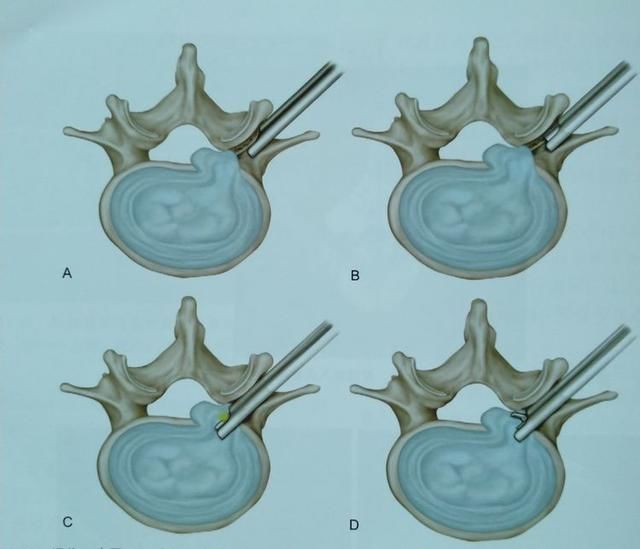 (椎间孔镜技术术中操作)