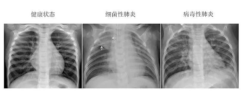 8%, 区分细菌性,病毒性肺炎的准确率达90%以上.