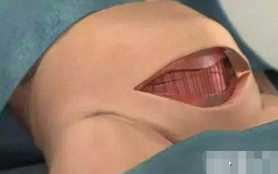 让人胆战心惊的剖腹产手术全过程图片 看完我傻了!