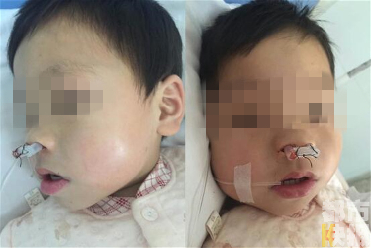新生男婴患先天双侧后鼻孔闭锁疾病 无法用鼻呼吸