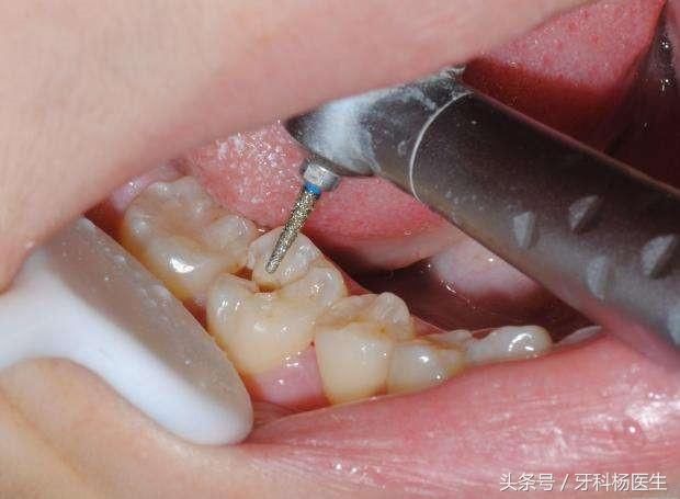 说好是去补牙的,牙医却要给我磨牙,牙洞越磨越大