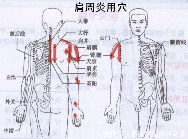 肩周炎的发生原因和诊断方法,运用针灸,刮痧,推拿治疗