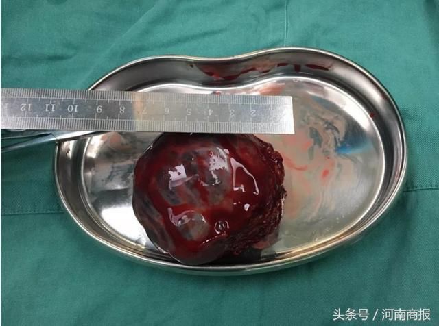 郑州一名女婴,还未出生就患上了恶性肿瘤