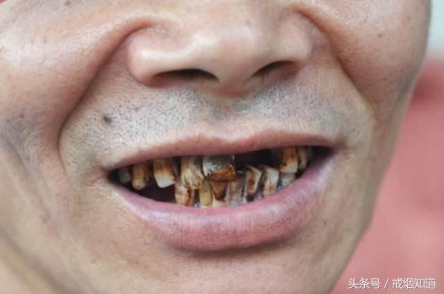 对于长期抽烟者来说,慢慢的牙渍和焦油黑斑一直是心中的痛,这样的