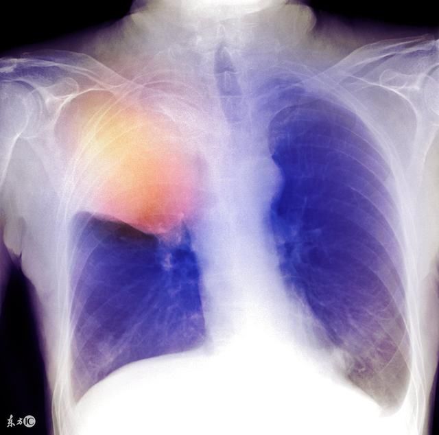 二十多岁的青年如有以下肺癌早期症状要警惕