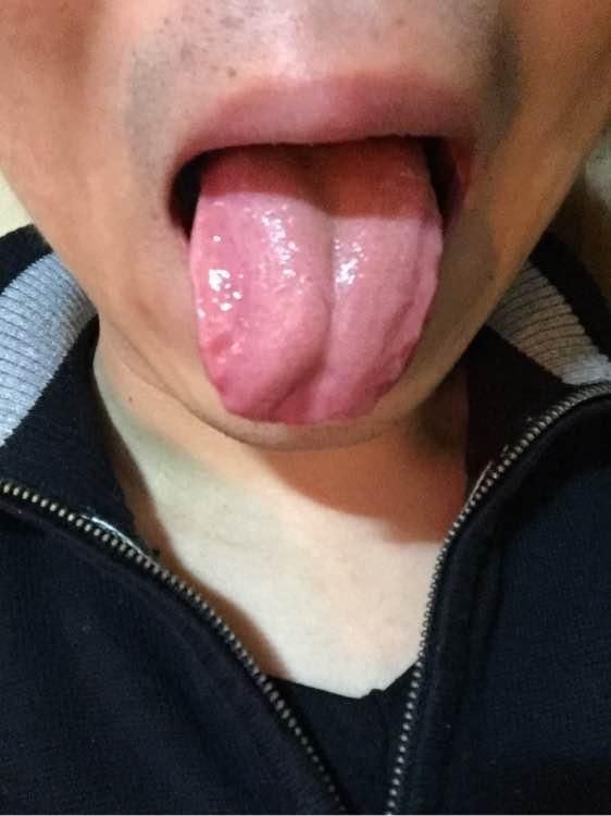 珍贵舌诊:脾肾阳虚,心肝火旺,气血不足的舌苔,看完记得存!