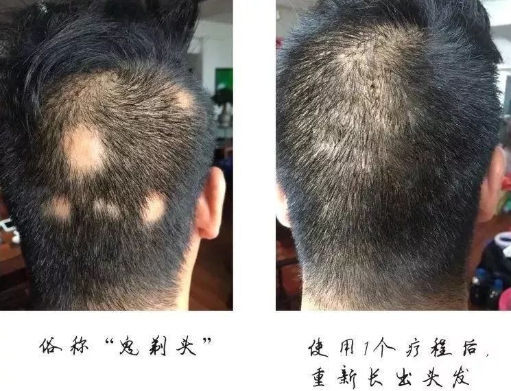 客户案例二:原来一直困扰在"鬼剃头"的尴尬,使用后原来没有头发的部分