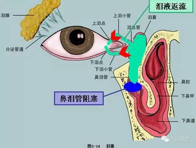 鼻泪管阻塞后怎么办1,按摩鼻泪管由上而下,在宝宝泪囊区按摩