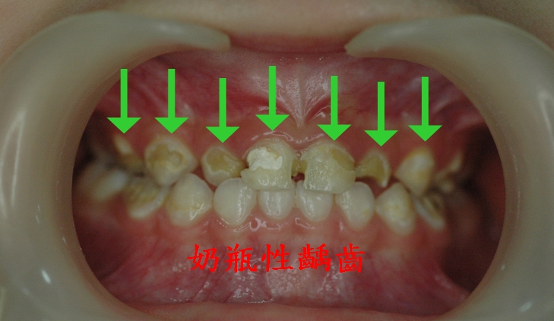 一周岁多的宝宝刚长出小牙却已"千疮百孔,警惕"奶瓶性蛀牙"