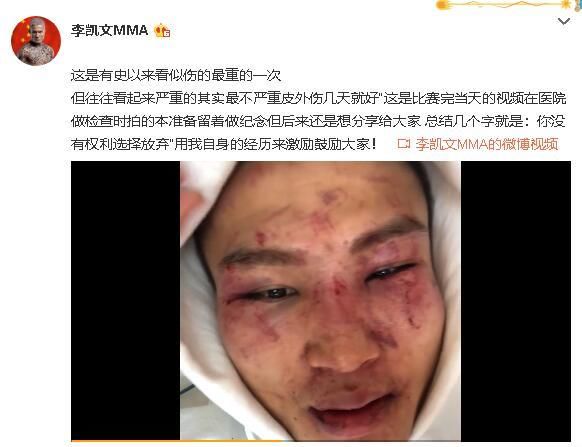 中国mma选手李凯文晒赛后伤情,曾炮轰一龙:丢人丢到国外去了