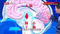 正常压力脑积水是怎么发生的？结合道具，专家给您详细讲解