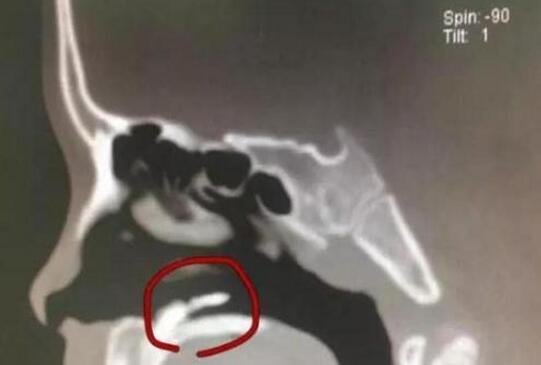 8岁男孩长期鼻塞流鼻涕 检查发现鼻腔内长出牙齿