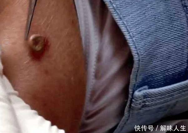 女子身上突然长出肉瘤, 医生检查才知不是肉瘤, 取出后仍十分后怕
