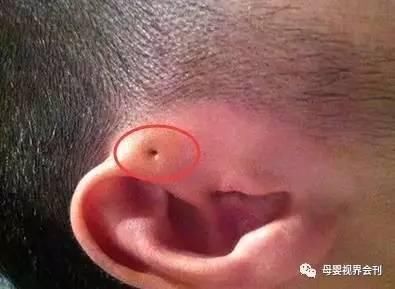 你家宝宝耳朵上有这种小孔吗?如果有,就要小心