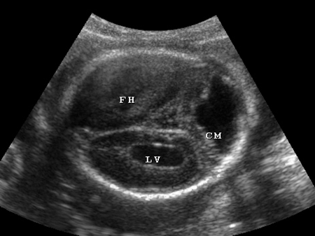 四维彩超侧脑室正常值 四维彩超侧脑室正常值