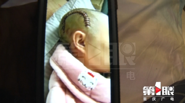 女子被家暴后求助媒体 4天后被丈夫打成颅骨骨