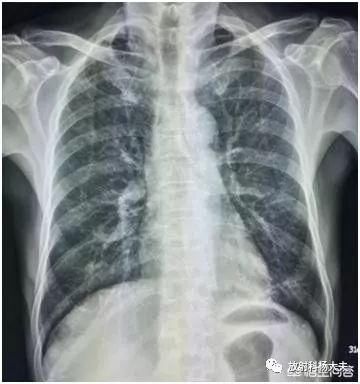 肺部CT做的节节,和胸片拍的密度增高影是一回