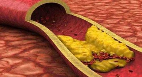 血脂高怎么办,多吃3种食物,通血管、清油脂,给