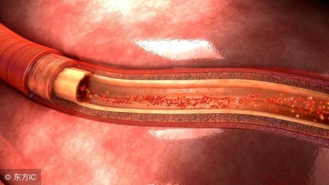 肺栓塞的病情通常很急,血管堵塞得多时可能窒息而死 严重时可能导致