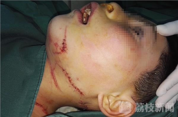 徐州一名十岁男孩遭邻居砍伤 面部9处伤口舌头断裂