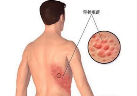 头皮是疼的,脸上是痒的,淋巴是肿的,马思纯带状