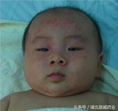 宝宝反复高烧不退,到底是什么原因?