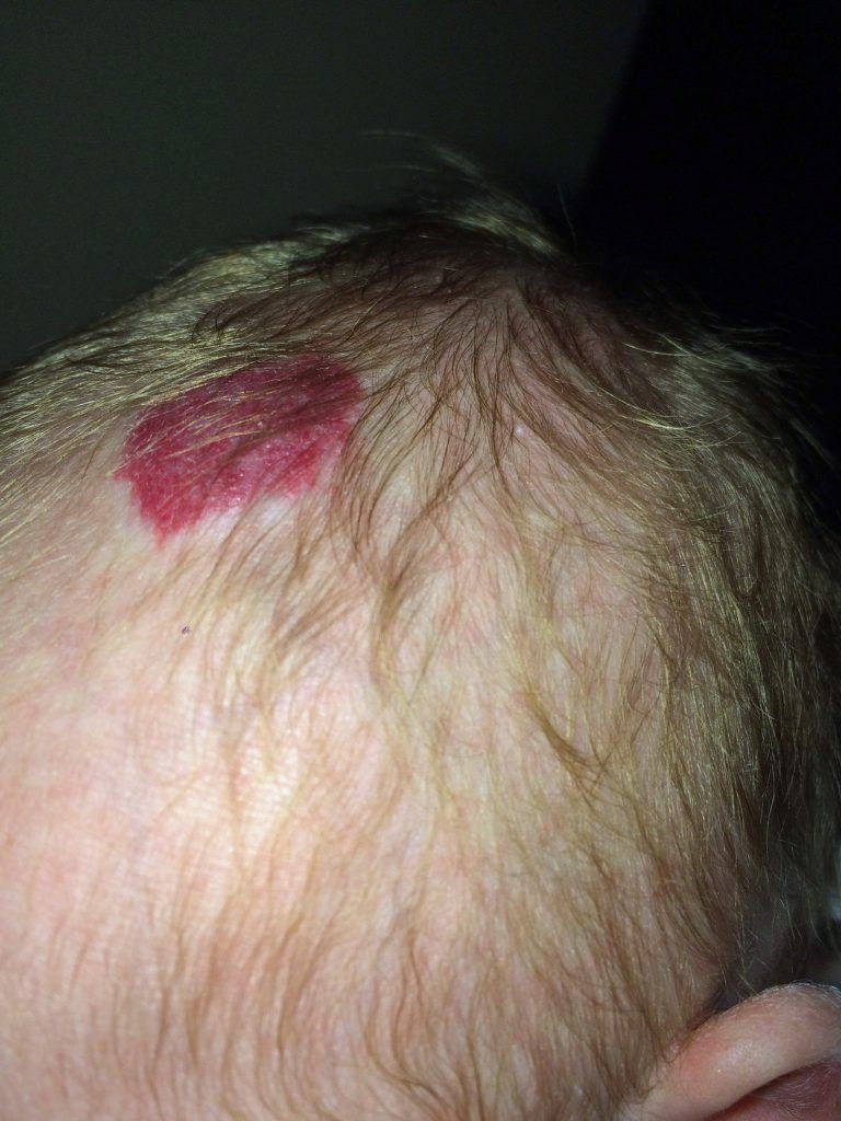 大家如果第一次见到这红红的斑点,会以为是什么呢?