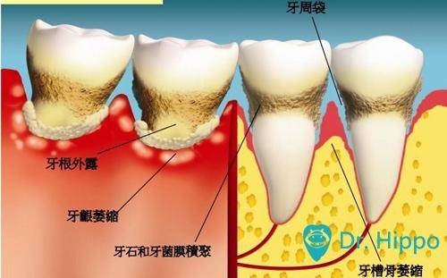 牙周病如何治疗?河马医生告诉你常见的牙周病手术