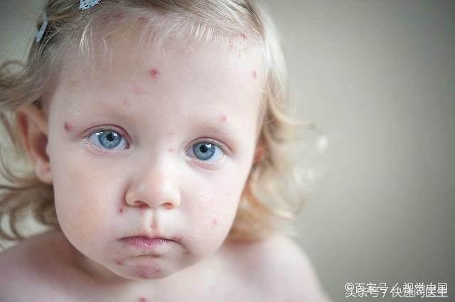 小孩出水痘饮食要注意哪些?避免添加剂过高的