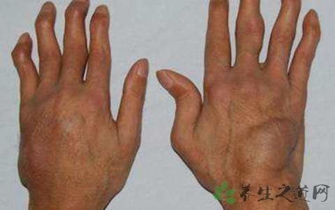 风湿膏过敏怎么办