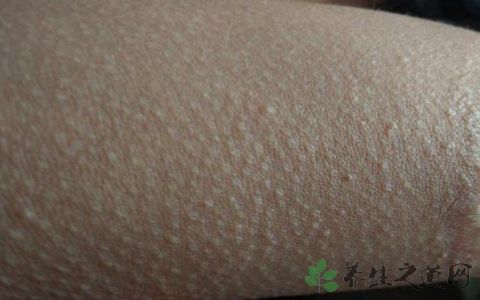 毛周角化症怎么治