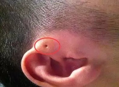 宝宝耳朵上有小孔?爱眼耳鼻喉专家带您认识