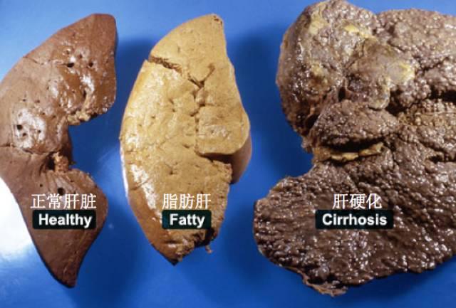 喝酒后肠胃不适,警惕酒精肝外还要学会解酒护